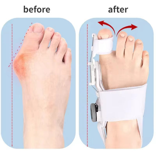 Bunion Corrector / Orthopedic Toe Straightener